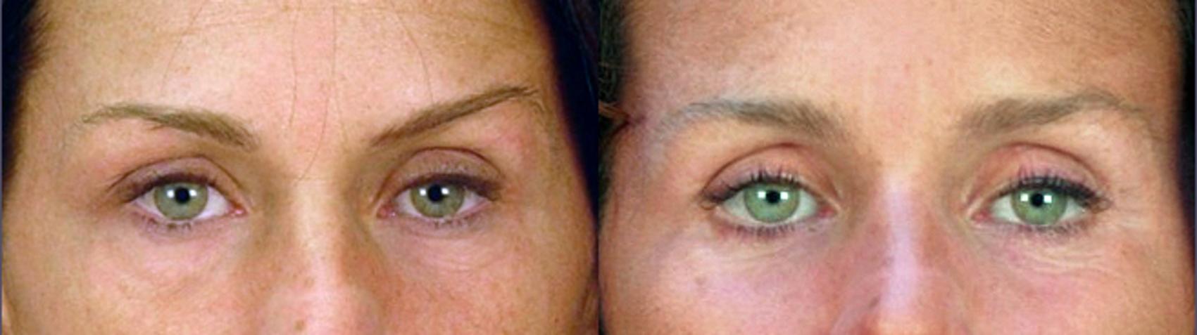 Eyelid Lift Case 55 Before & After View #1 | Paramus, New Jersey | Parker Center for Plastic Surgery