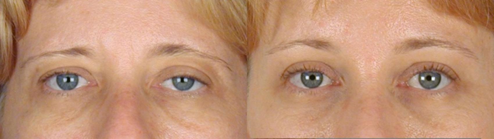 Eyelid Lift Case 56 Before & After View #1 | Paramus, New Jersey | Parker Center for Plastic Surgery
