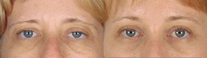 Eyelid Lift Case 56 Before & After View #1 | Paramus, New Jersey | Parker Center for Plastic Surgery