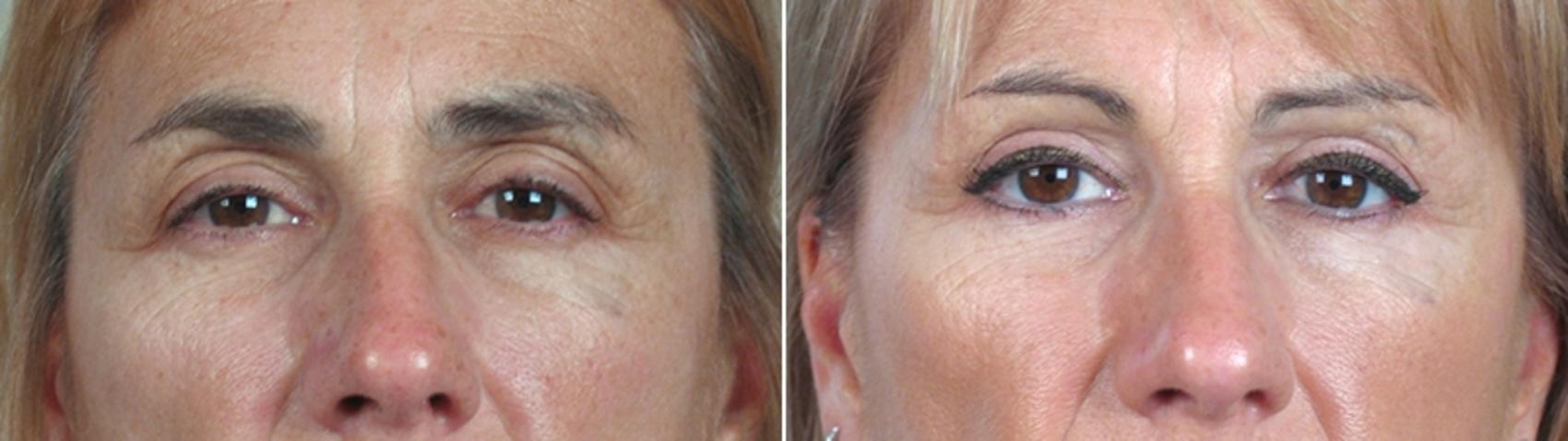 Eyelid Lift Case 57 Before & After View #1 | Paramus, New Jersey | Parker Center for Plastic Surgery