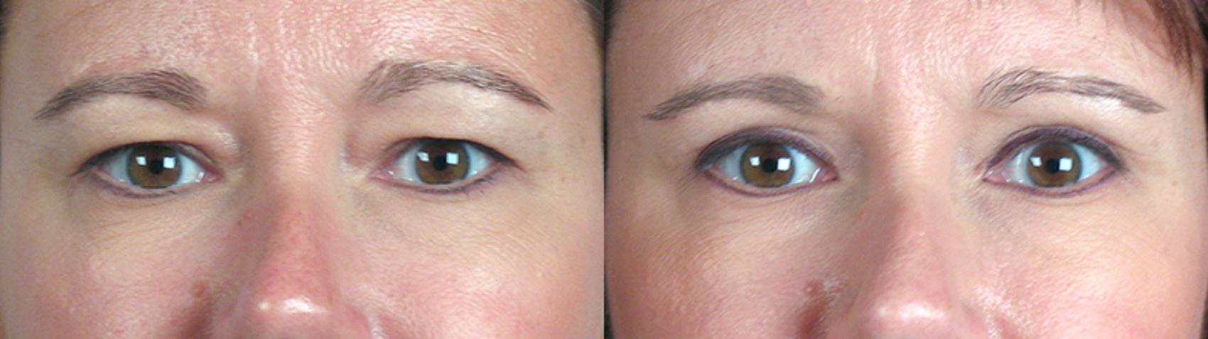 Eyelid Lift Case 58 Before & After View #1 | Paramus, New Jersey | Parker Center for Plastic Surgery