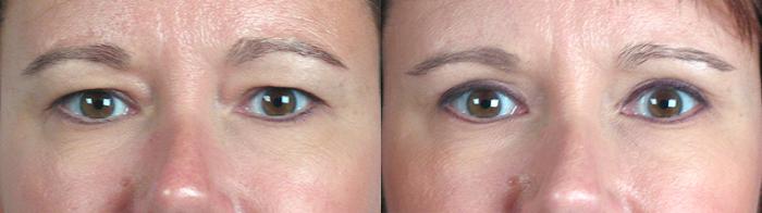 Eyelid Lift Case 58 Before & After View #1 | Paramus, New Jersey | Parker Center for Plastic Surgery