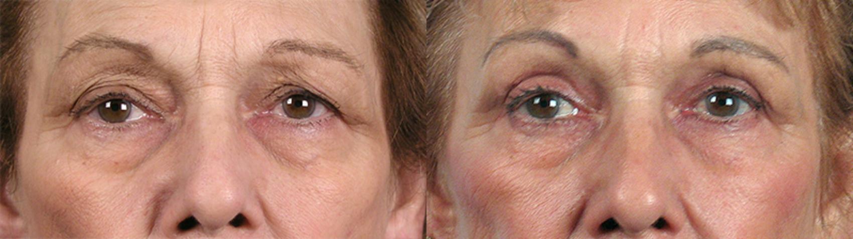 Eyelid Lift Case 60 Before & After View #1 | Paramus, New Jersey | Parker Center for Plastic Surgery