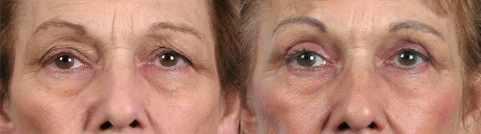 Eyelid Lift Case 60 Before & After View #1 | Paramus, New Jersey | Parker Center for Plastic Surgery