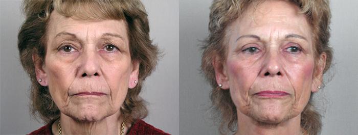 Eyelid Lift Case 60 Before & After View #2 | Paramus, New Jersey | Parker Center for Plastic Surgery