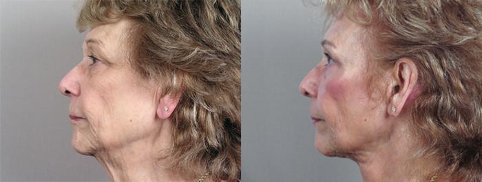 Eyelid Lift Case 60 Before & After View #3 | Paramus, New Jersey | Parker Center for Plastic Surgery
