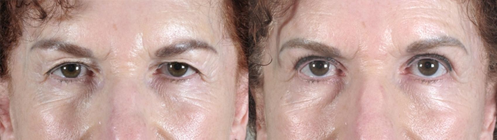 Eyelid Lift Case 61 Before & After View #1 | Paramus, New Jersey | Parker Center for Plastic Surgery