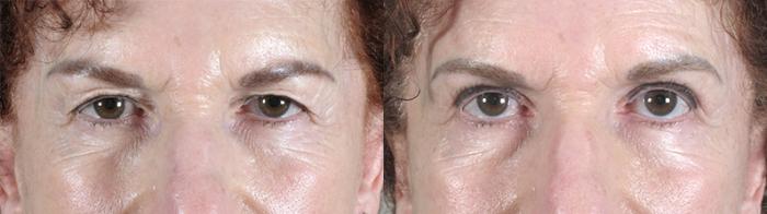 Eyelid Lift Case 61 Before & After View #1 | Paramus, New Jersey | Parker Center for Plastic Surgery