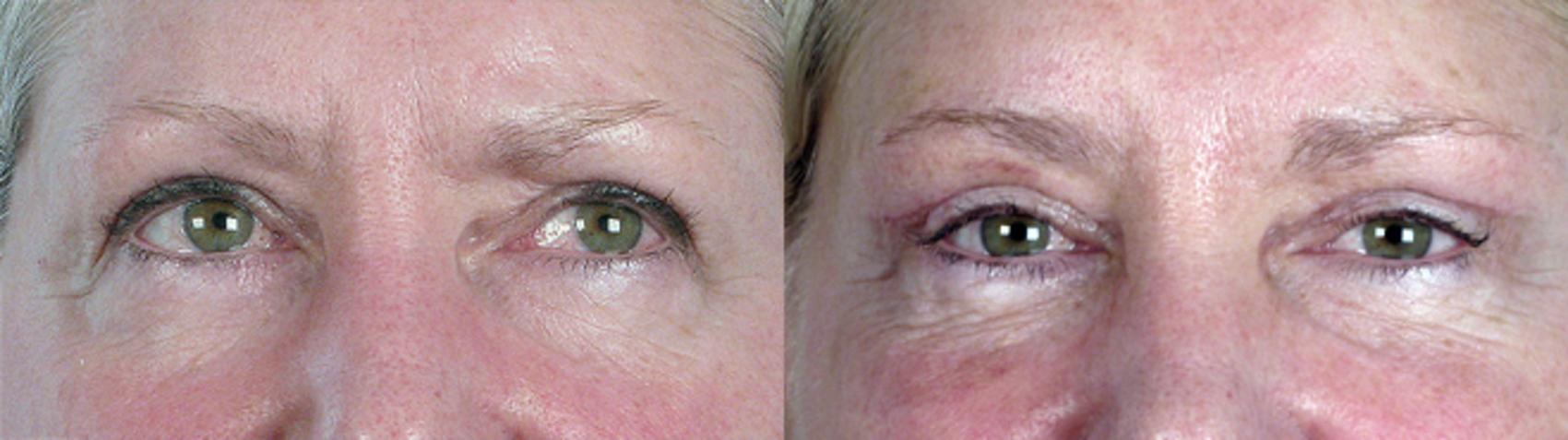 Eyelid Lift Case 62 Before & After View #1 | Paramus, New Jersey | Parker Center for Plastic Surgery