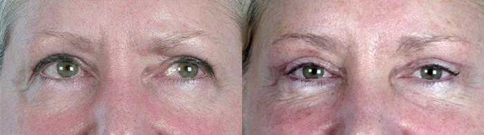Eyelid Lift Case 62 Before & After View #1 | Paramus, New Jersey | Parker Center for Plastic Surgery