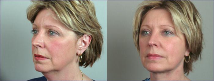 Eyelid Lift Case 63 Before & After View #1 | Paramus, New Jersey | Parker Center for Plastic Surgery