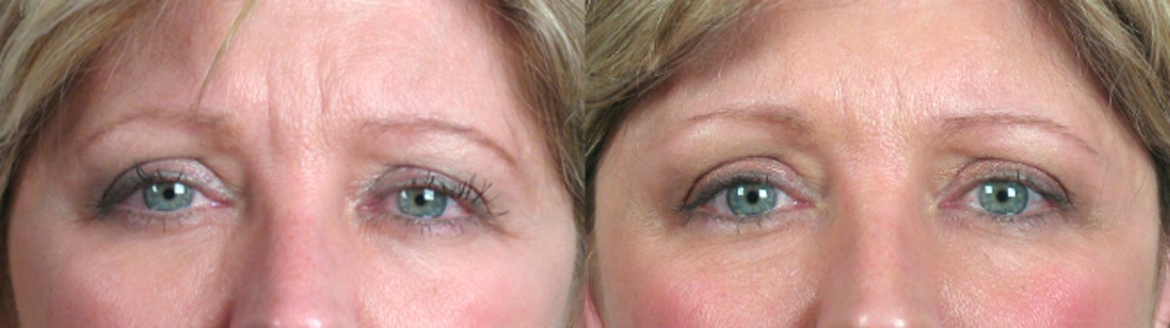 Eyelid Lift Case 63 Before & After View #2 | Paramus, New Jersey | Parker Center for Plastic Surgery