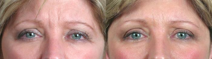 Eyelid Lift Case 63 Before & After View #2 | Paramus, New Jersey | Parker Center for Plastic Surgery