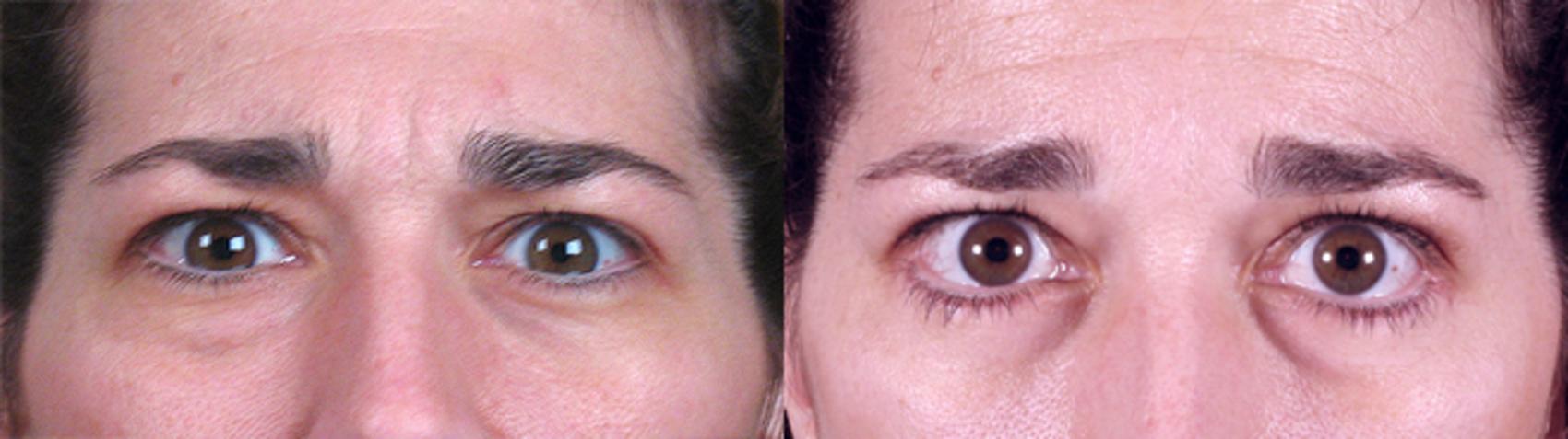 Eyelid Lift Case 64 Before & After View #1 | Paramus, New Jersey | Parker Center for Plastic Surgery