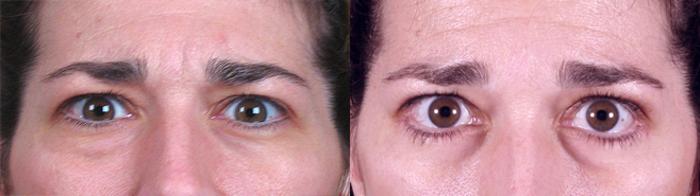 Eyelid Lift Case 64 Before & After View #1 | Paramus, New Jersey | Parker Center for Plastic Surgery