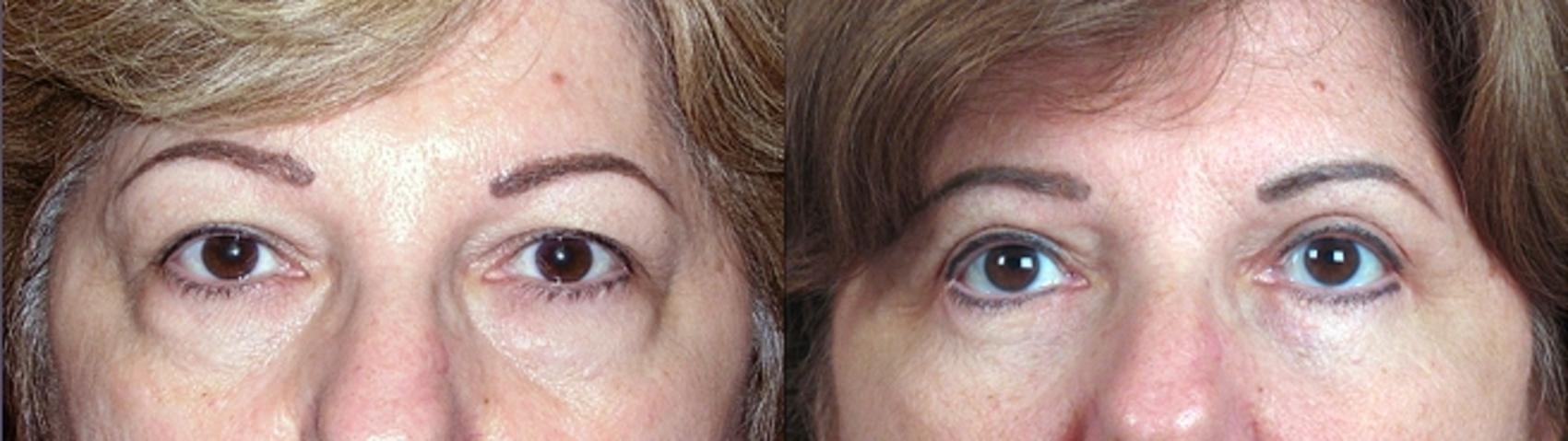Eyelid Lift Case 65 Before & After View #1 | Paramus, New Jersey | Parker Center for Plastic Surgery