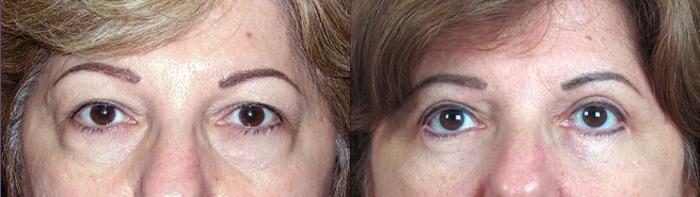 Eyelid Lift Case 65 Before & After View #1 | Paramus, New Jersey | Parker Center for Plastic Surgery