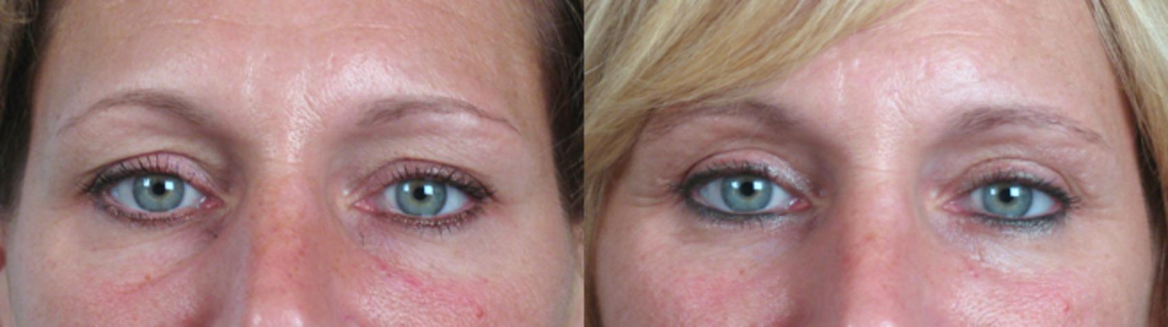 Eyelid Lift Case 67 Before & After View #1 | Paramus, New Jersey | Parker Center for Plastic Surgery