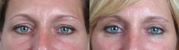 Eyelid Lift Case 67 Before & After View #1 | Paramus, New Jersey | Parker Center for Plastic Surgery