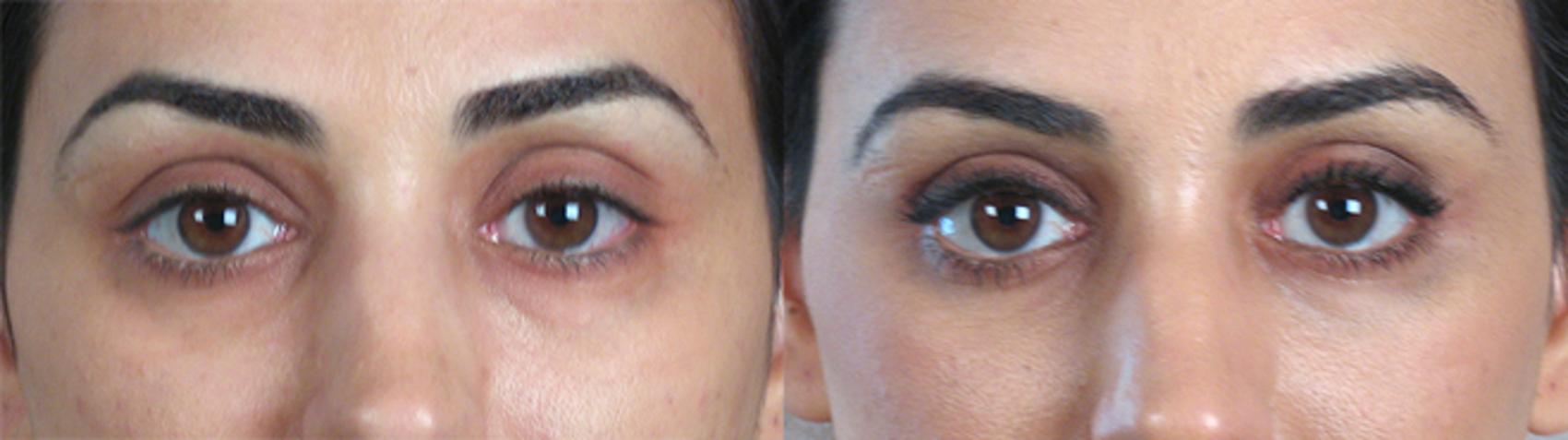 Eyelid Lift Case 69 Before & After View #1 | Paramus, New Jersey | Parker Center for Plastic Surgery