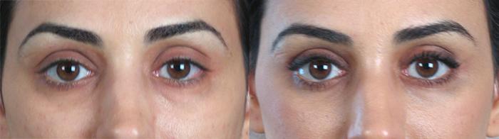 Eyelid Lift Case 69 Before & After View #1 | Paramus, New Jersey | Parker Center for Plastic Surgery