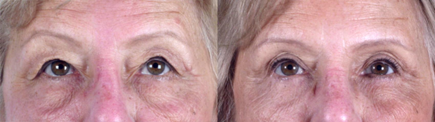 Eyelid Lift Case 70 Before & After View #1 | Paramus, New Jersey | Parker Center for Plastic Surgery