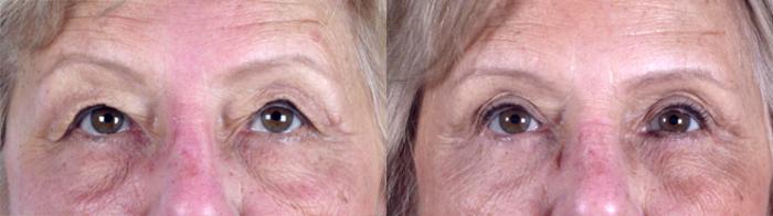 Eyelid Lift Case 70 Before & After View #1 | Paramus, New Jersey | Parker Center for Plastic Surgery