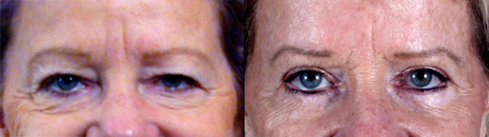 Eyelid Lift Case 71 Before & After View #1 | Paramus, New Jersey | Parker Center for Plastic Surgery