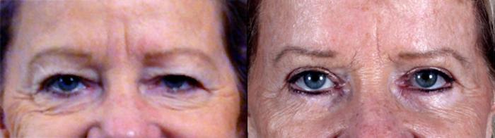 Eyelid Lift Case 71 Before & After View #1 | Paramus, New Jersey | Parker Center for Plastic Surgery
