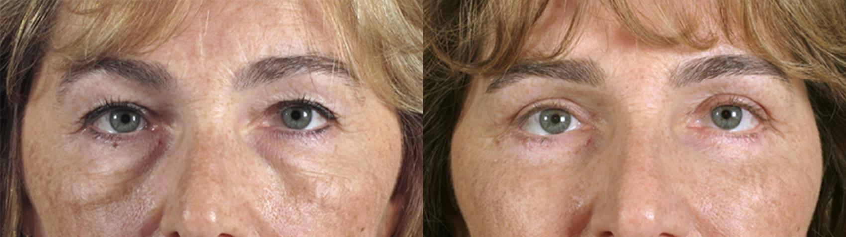 Eyelid Lift Case 73 Before & After View #1 | Paramus, New Jersey | Parker Center for Plastic Surgery