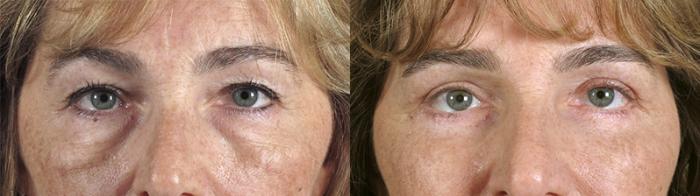 Eyelid Lift Case 73 Before & After View #1 | Paramus, New Jersey | Parker Center for Plastic Surgery