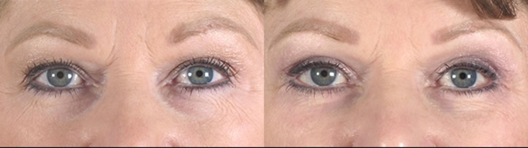 Eyelid Lift Case 74 Before & After View #1 | Paramus, New Jersey | Parker Center for Plastic Surgery