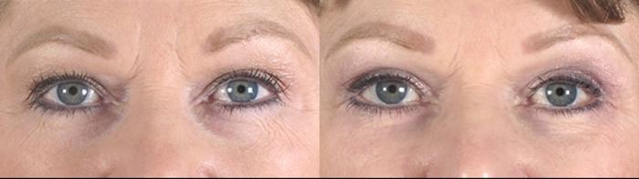 Eyelid Lift Case 74 Before & After View #1 | Paramus, New Jersey | Parker Center for Plastic Surgery