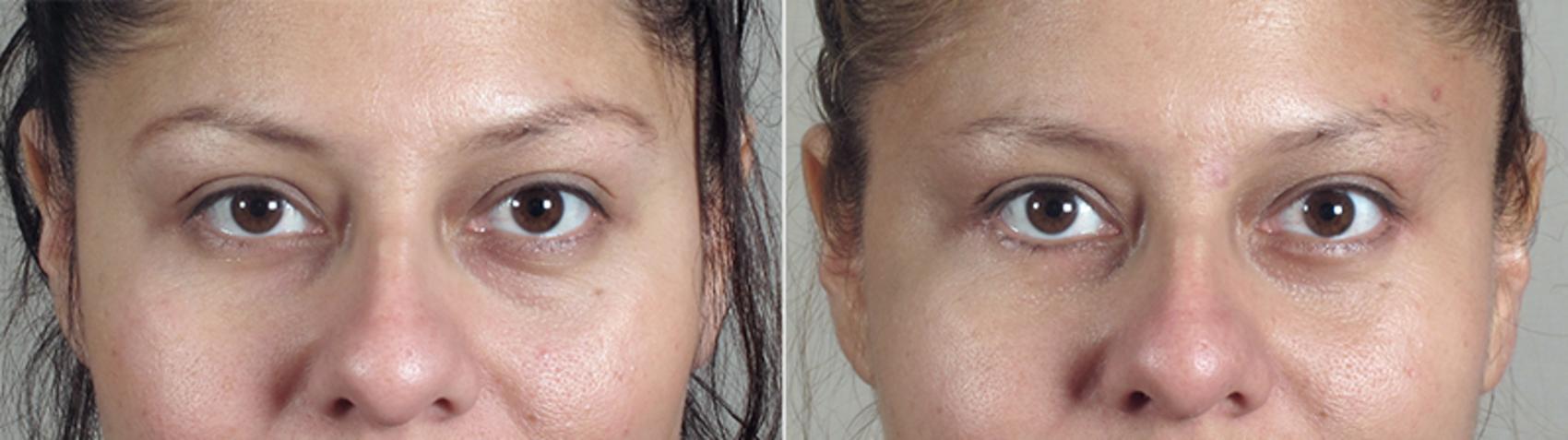 Eyelid Lift Case 76 Before & After View #1 | Paramus, New Jersey | Parker Center for Plastic Surgery