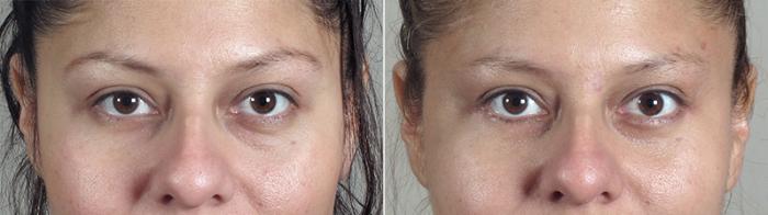Eyelid Lift Case 76 Before & After View #1 | Paramus, New Jersey | Parker Center for Plastic Surgery