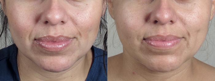 Eyelid Lift Case 76 Before & After View #2 | Paramus, New Jersey | Parker Center for Plastic Surgery