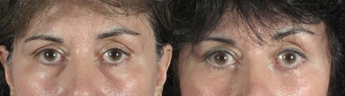 Eyelid Lift Case 78 Before & After View #1 | Paramus, New Jersey | Parker Center for Plastic Surgery