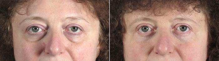 Eyelid Lift Case 79 Before & After View #1 | Paramus, New Jersey | Parker Center for Plastic Surgery