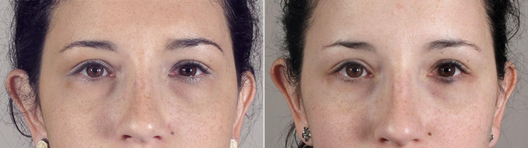 Eyelid Lift Case 80 Before & After View #1 | Paramus, New Jersey | Parker Center for Plastic Surgery
