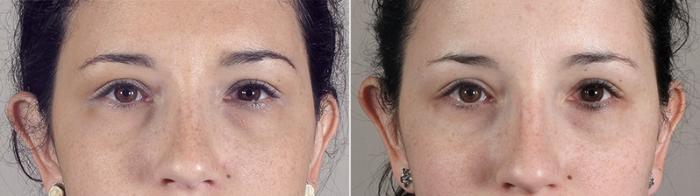 Eyelid Lift Case 80 Before & After View #1 | Paramus, New Jersey | Parker Center for Plastic Surgery