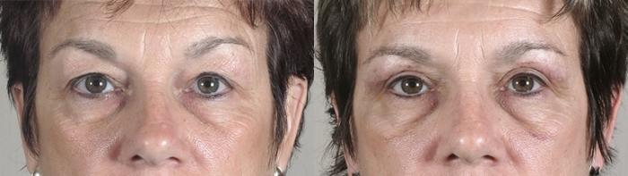 Lip Enhancement Case 82 Before & After View #1 | Paramus, New Jersey | Parker Center for Plastic Surgery