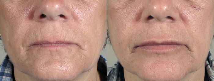 Lip Enhancement Case 82 Before & After View #2 | Paramus, New Jersey | Parker Center for Plastic Surgery