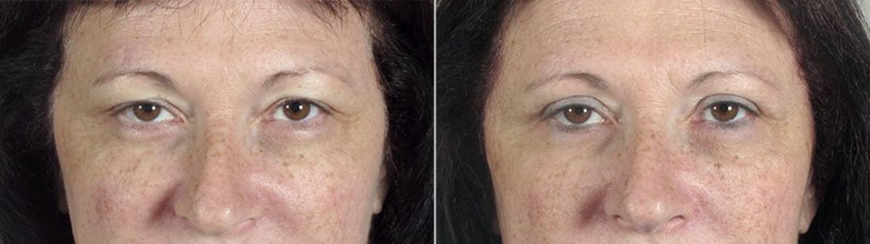 Eyelid Lift Case 84 Before & After View #1 | Paramus, New Jersey | Parker Center for Plastic Surgery