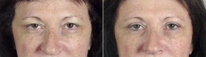 Eyelid Lift Case 84 Before & After View #1 | Paramus, New Jersey | Parker Center for Plastic Surgery