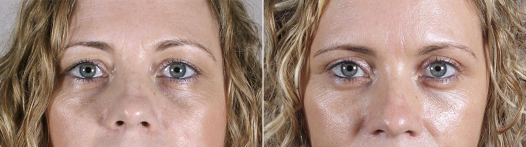 Eyelid Lift Case 85 Before & After View #1 | Paramus, New Jersey | Parker Center for Plastic Surgery