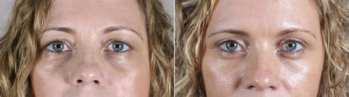 Eyelid Lift Case 85 Before & After View #1 | Paramus, New Jersey | Parker Center for Plastic Surgery