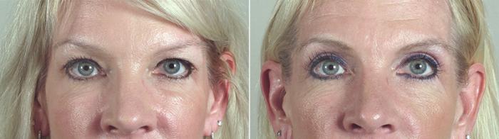 Eyelid Lift Case 86 Before & After View #1 | Paramus, New Jersey | Parker Center for Plastic Surgery