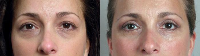 Eyelid Lift Case 87 Before & After View #1 | Paramus, New Jersey | Parker Center for Plastic Surgery