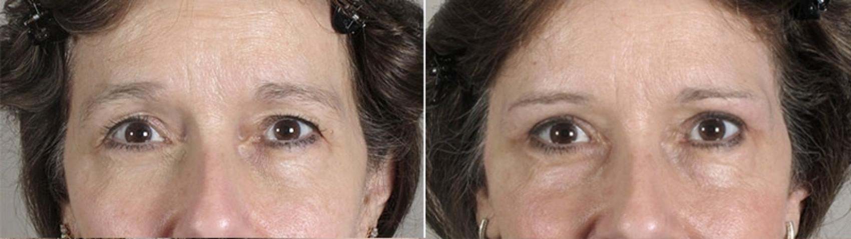 Eyelid Lift Case 871 Before & After View #4 | Paramus, New Jersey | Parker Center for Plastic Surgery