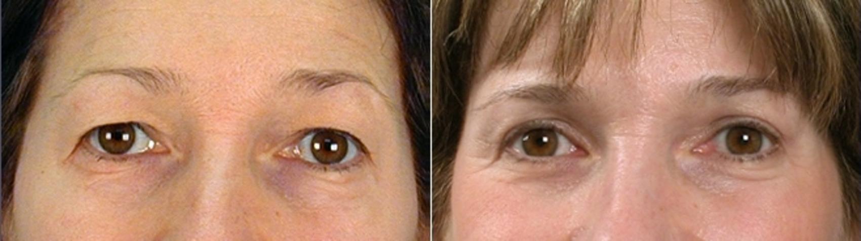 Eyelid Lift Case 875 Before & After View #4 | Paramus, New Jersey | Parker Center for Plastic Surgery